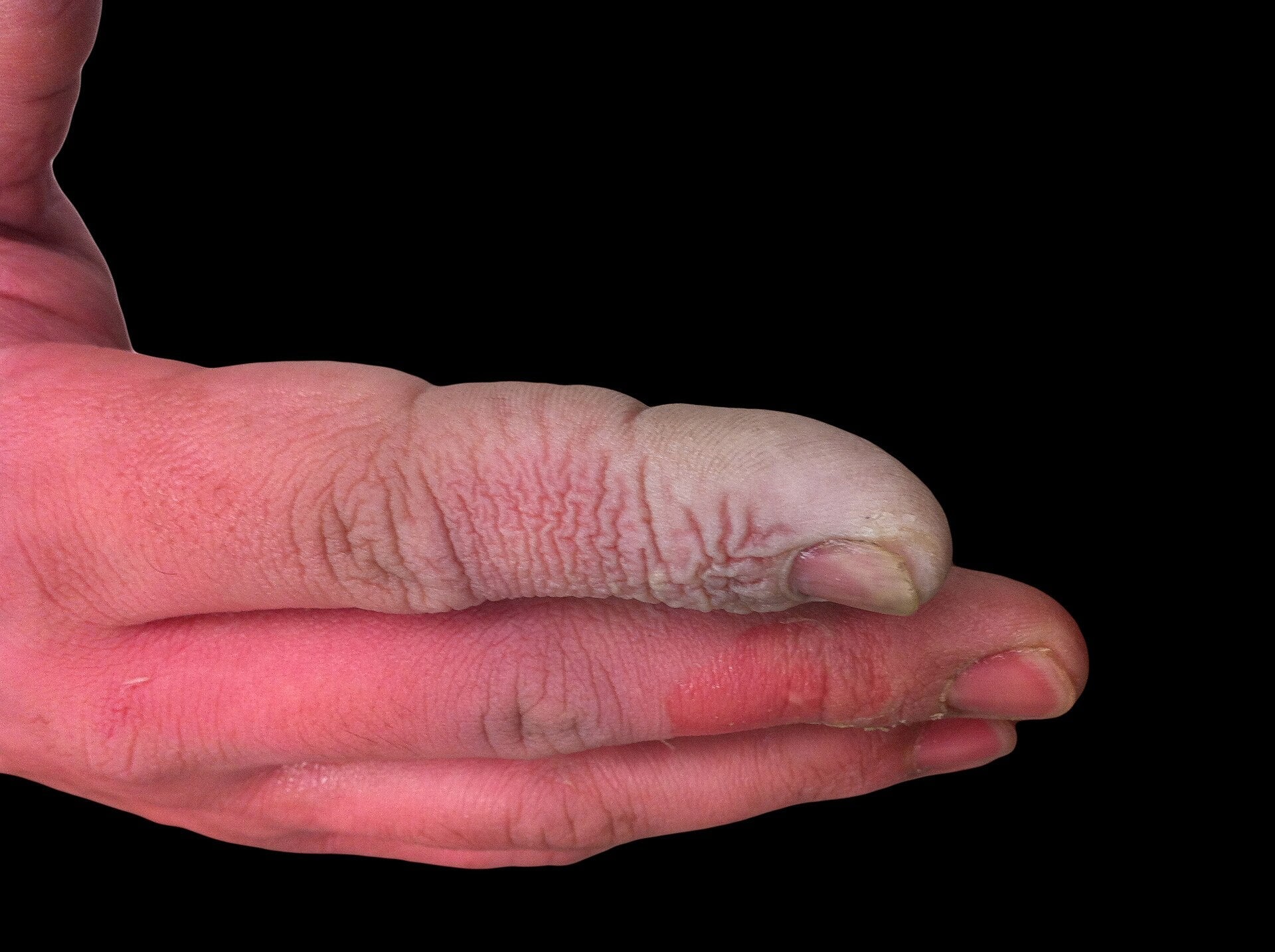 How to treat Hydrofluoric Acid Burns