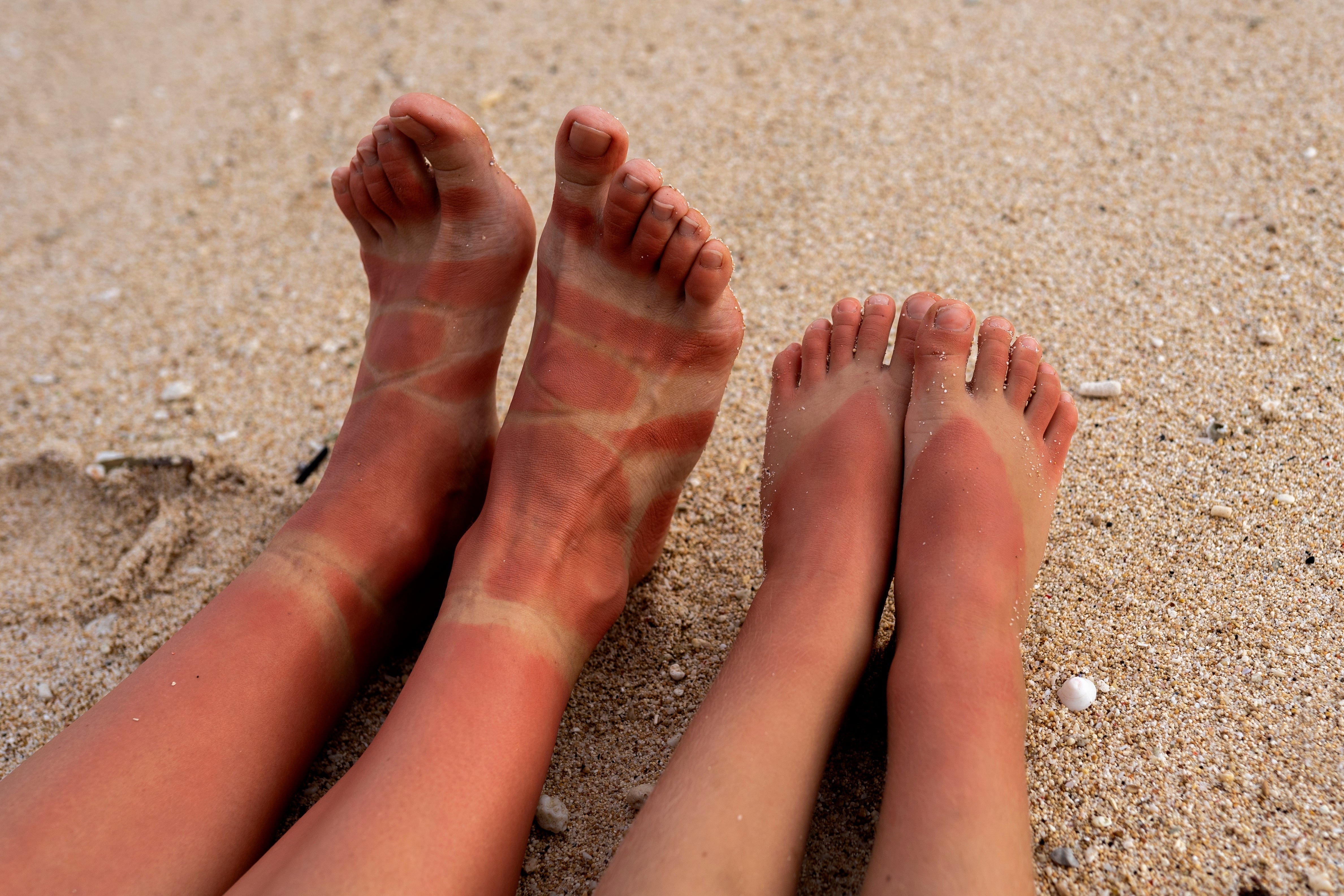 Top 3 Summer first aid injuries (and how to treat them!)